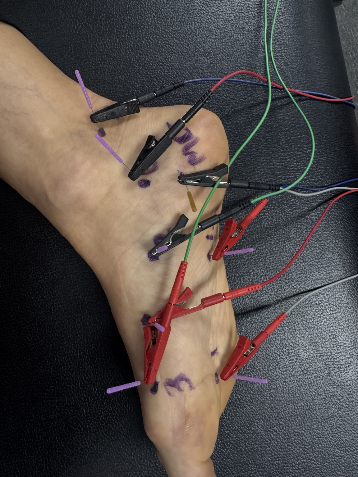 Dry needling needles at the ankle and foot with electrical leads attached.