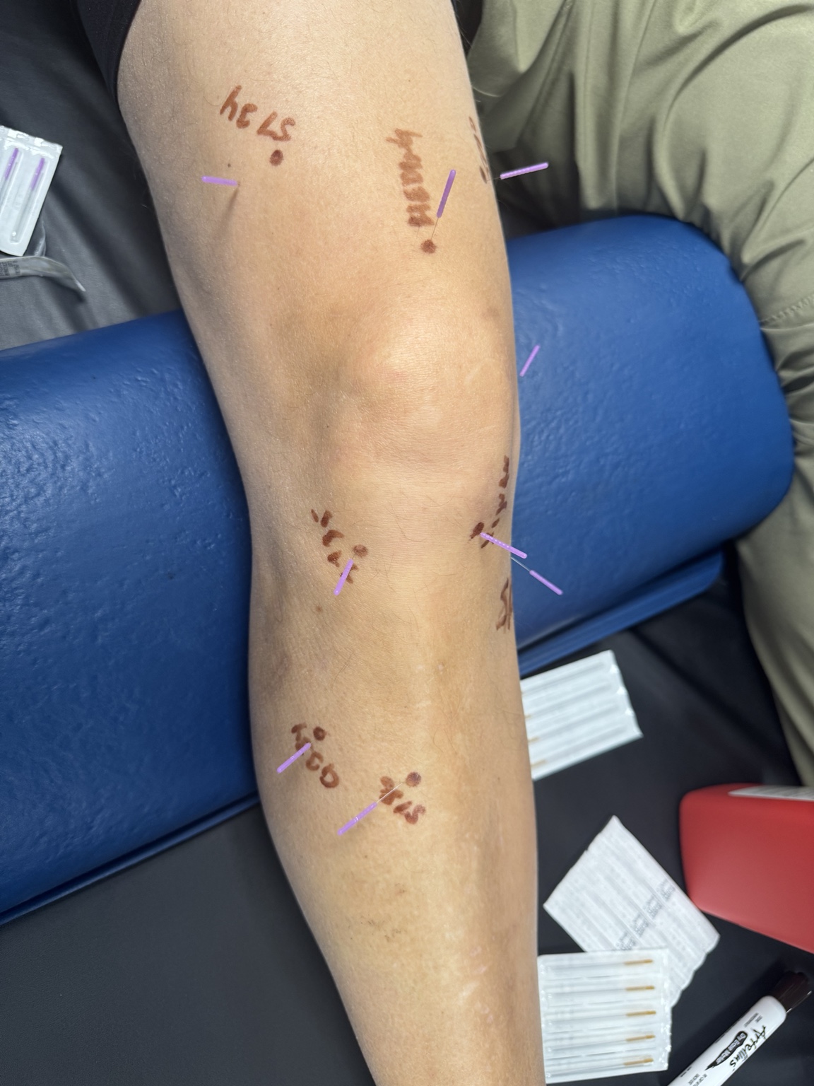Dry needling needles around the knee with the leg supported on a bolster.