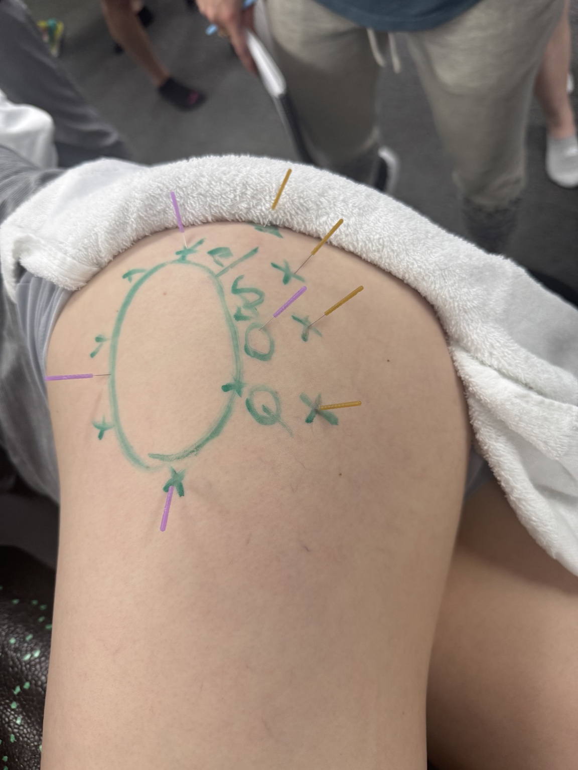 Close-up of dry needling needles and treatment markings at the shoulder.