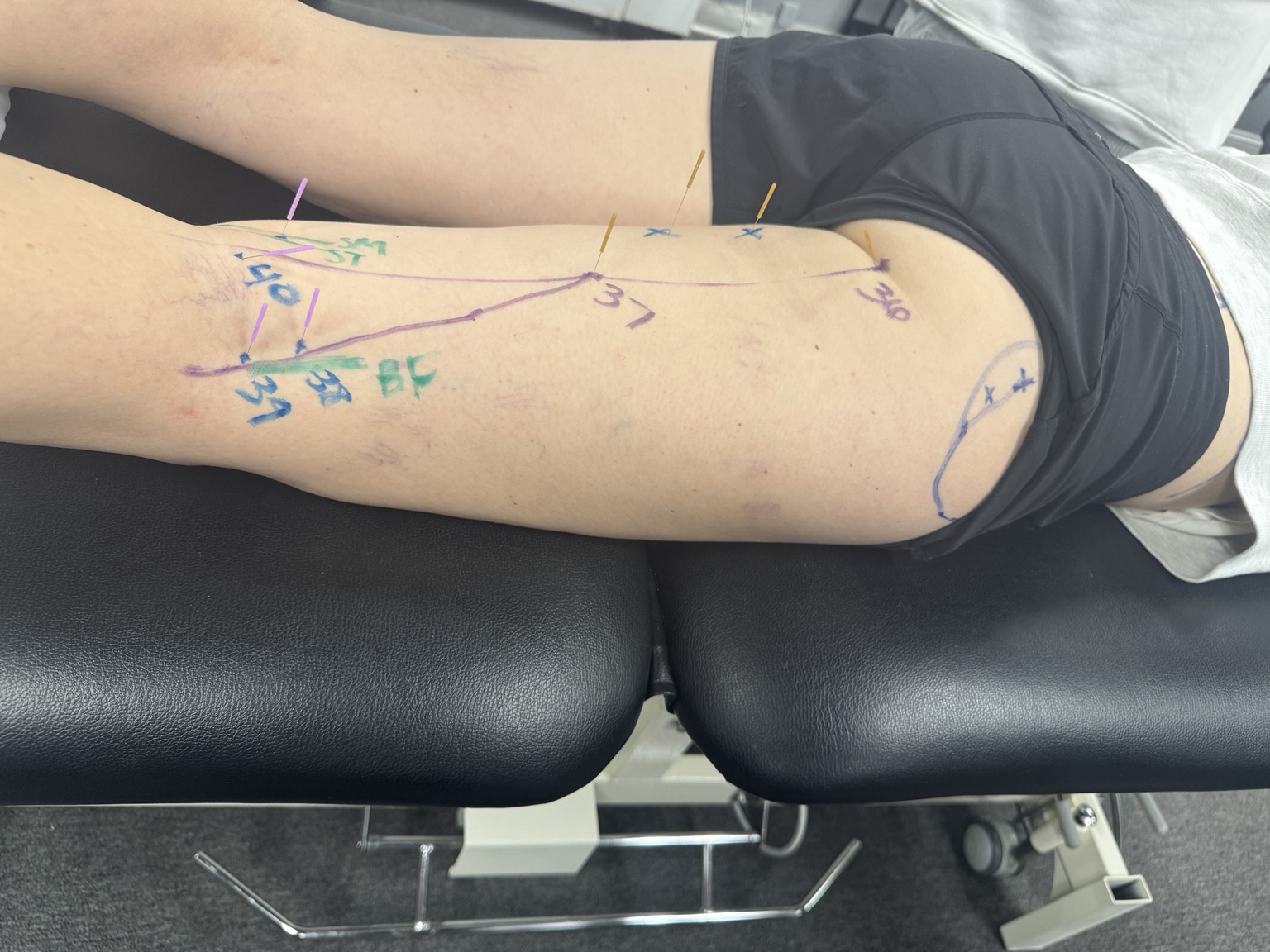 Dry needling needles and treatment markings along the back of the thigh.