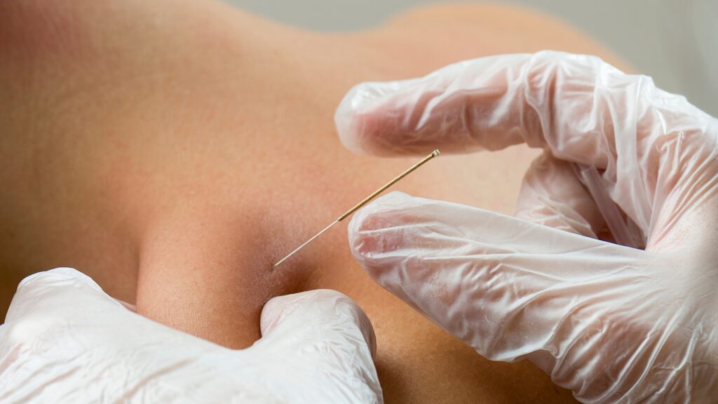 Needle therapy treatment comparison